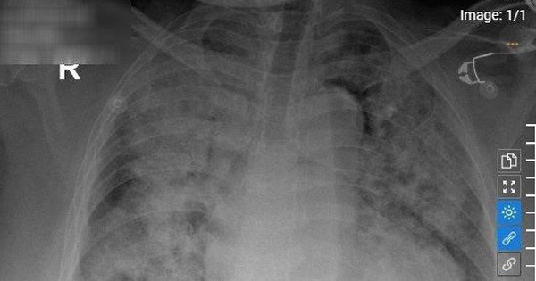 Hai phổi trắng xóa, nhiễm trùng máu nguy kịch do 3 sai lầm rất thường gặp ở người Việt
