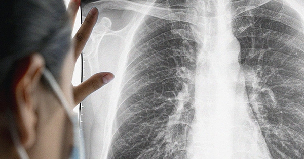 Người đàn ông mắc ung thư phổi sau nhiều năm duy trì một thói quen khó bỏ ở đàn ông Việt