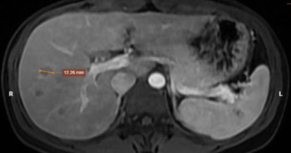 Người phụ nữ bỗng phát hiện gan, phổi tổn thương: Bác sĩ chỉ đích danh 2 thói quen làm tăng nguy cơ