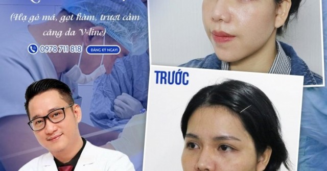 Xu hướng thẩm mỹ mặt V-Line trái xoan với phẫu thuật đường viền khuôn mặt cùng Tiến sĩ, Bác sĩ Đỗ Thành Trí